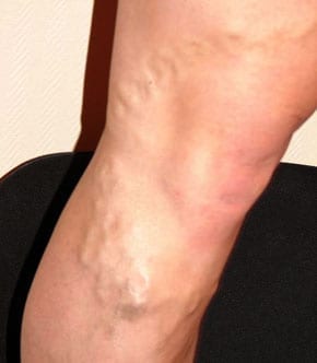 ranit piciorul sub genunchi varicoza